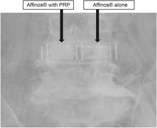 Effect of platelet-rich plasma on the acceleration of graft bone catabolism in lateral lumbar interbody fusion in a short-term assessment.