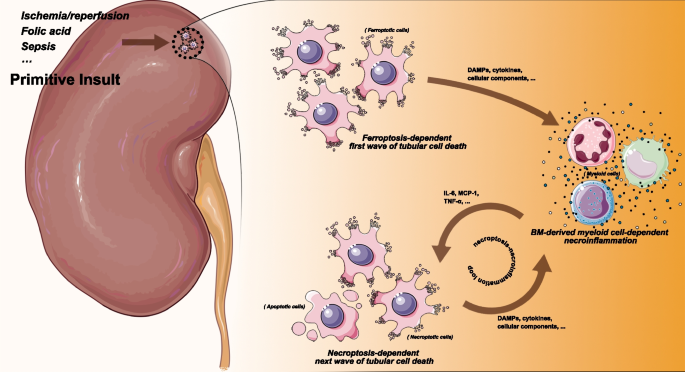 Identification of potential necroinflammation-associated necroptosis-related biomarkers for delayed graft function and renal allograft failure: a machine learning-based exploration in the framework of predictive, preventive, and personalized medicine.