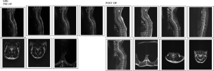 Acute presentation of Chiari malformation type I in adulthood with arm swelling, a case report and literature review.