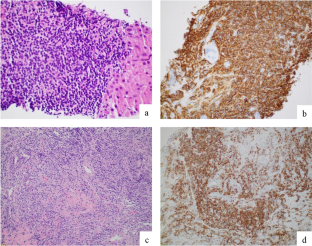 Clonal relationship of extranodal marginal zone lymphomas of mucosa-associated lymphoid tissue (MALT lymphoma) involving multiple organ systems with review of the literature