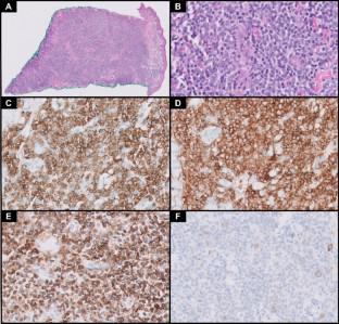 Two cases of mycosis fungoides with large cell transformation with KMT2A rearrangements