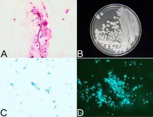 Candida guilliermondii/Kodamaea ohmeri Endocarditis.