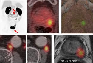 PSMA PET/CT imaging for biochemical recurrence of prostate cancer after radiotherapy: is it necessary to review the Phoenix criteria?