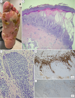 Trouble afoot: Mycosis fungoides bullosa at an unusual site.