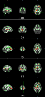 White and Gray Matter Abnormalities in Young Adult Females with Dependent Personality Disorder: A Diffusion-Tensor Imaging and Voxel-Based Morphometry Study.