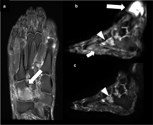 How to do and evaluate DWI and DCE-MRI sequences for diabetic foot assessment.