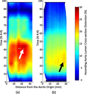 Ascending Aorta 4D Time to Peak Distention Sexual Dimorphism and Association with Coronary Plaque Burden Severity in Women.