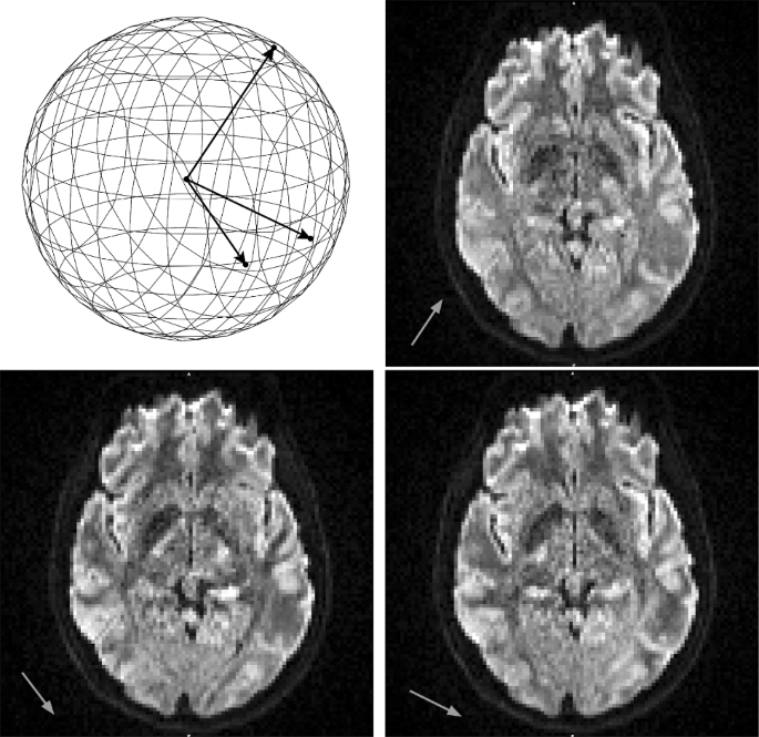 Combining Image Space and q-Space PDEs for Lossless Compression of Diffusion MR Images