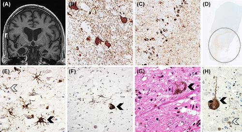 Concomitant progressive supranuclear palsy and Lewy body pathology presenting with circumscribed visual memory loss: A clinicopathological case