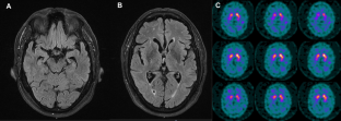 Whole-exome sequencing reveals PSEN1 and ATP7B combined variants as a possible cause of early-onset Lewy body dementia: a case study of genotype-phenotype correlation.