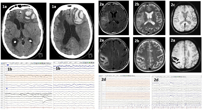 Diagnosis and Treatment of Poststroke Epilepsy: Where Do We Stand?