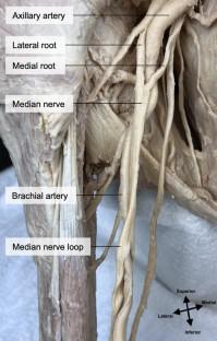 Variation of the brachial artery emerging through an opening in the median nerve: a case report.