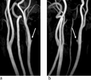 A nonbifurcating cervical carotid artery with a remnant of the proximal internal carotid artery that mimicked an aneurysm on magnetic resonance angiography.