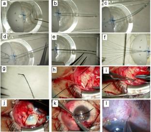 Surgical safety and efficacy of a multi-stent system, the comet stent, in Baerveldt glaucoma implant surgery: a prospective pilot study.