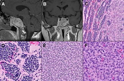 Sarcomatous Transformation of a Medically Treated Lactotroph Pituitary Neuroendocrine Tumor?