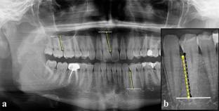 Dental radiographic changes in individuals with COVID-19: a controlled retrospective study.