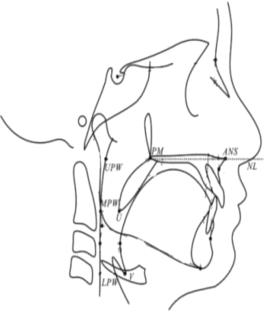 Cephalometric evaluation of pharyngeal airway and tongue space following treatment with Herbst and AdvanSync appliances : A prospective randomized clinical trial.