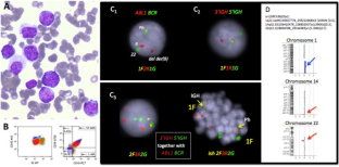 Chronic myeloid leukaemia (CML) presenting in B-lymphoblastic crisis: a diagnostic challenge