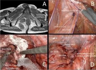 Navigating uncharted territory: robotic repair of a rare primary perineal hernia.