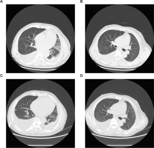 A rare case of fluid overload-associated large B-cell lymphoma and antigen loss at relapse