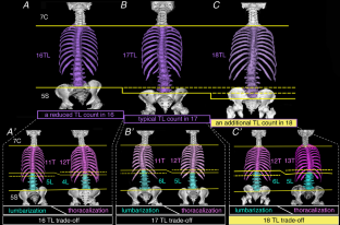 Prominent caudal shift of the lumbar plexus roots in spines with 18 thoracolumbar vertebrae.