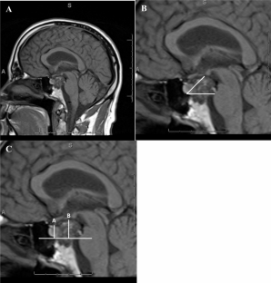 Incidence of postoperative hyponatremia after endoscopic endonasal pituitary transposition for skull base pathologies.