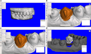 Surface wear and adhesive failure of resin attachments used in clear aligner orthodontic treatment.