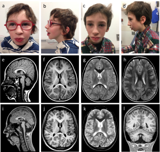 A Cockayne-like phenotype resulting from a de novo variant in MORC2: expanding the phenotype of MORC2-related disorders.