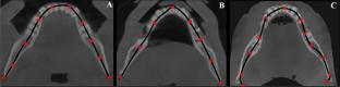 Influence of CBCT-derived panoramic curve variability in the measurements for dental implant planning.