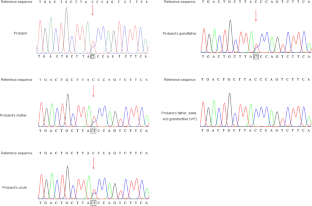 A newly detected c.180 + 1G > A variant causes a decrease of FGA transcription in patients with congenital hypo-dysfibrinogenemia