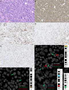 "Quadruple-hit" primary testicular diffuse large B-cell lymphoma with MYD88 L265P mutation, IGH::MYC, and IRF4- and BCL6-rearrangements.