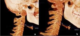 Evaluation of the influence of hyoid bone position, volume, and types on pharyngeal airway volume and cephalometric measurements.