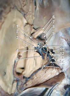 Fenestration of posterior cerebral artery at the junction of P1 and P2 segments.