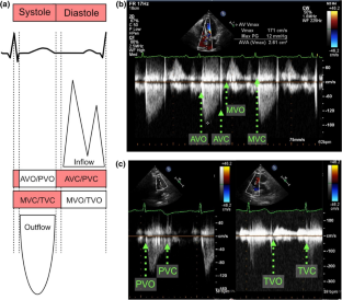 Electrocardiogram to Determine Mitral and Aortic Valve Opening and Closure.