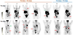 PET receptor imaging in breast cancer