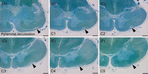 Degeneration of olivospinal tract in the upper cervical spinal cord of multiple system atrophy patients: Reappraisal of Helweg's triangular tract