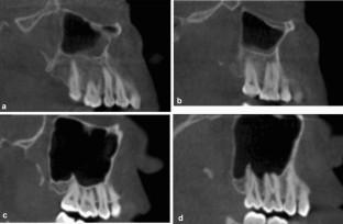 Proximity of healthy posterior teeth to the maxillary sinus floor in relation to mucosal thickening: a CBCT study.