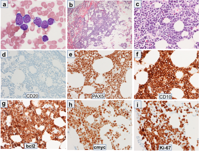 B-lymphoblastic leukemia/lymphoma with MYC and BCL2 gene rearrangements shows evidence for clonal evolution and mitotic recombination.