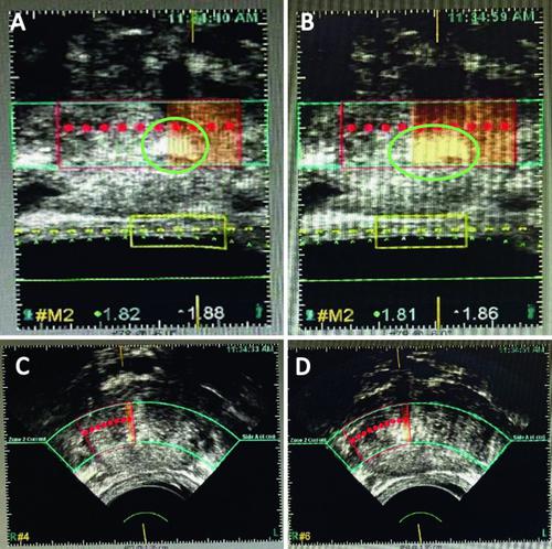 Real-Time and Delayed Imaging of Tissue and Effects of Prostate Tissue Ablation.