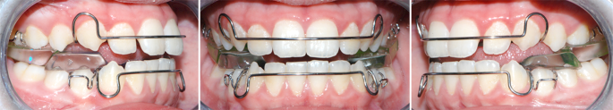 Dentoskeletal effects of clear aligner vs twin block-a short-term study of functional appliances.