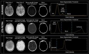 Cranial bone imaging using ultrashort echo-time bone-selective MRI as an alternative to gradient-echo based "black-bone" techniques.