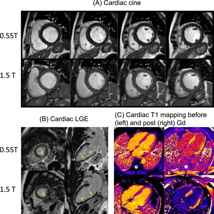 New clinical opportunities of low-field MRI: heart, lung, body, and musculoskeletal.