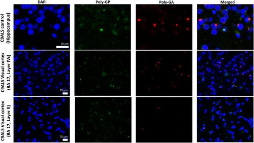 Primary visual cortex pathology in ALS patients with C9ORF72 expansion