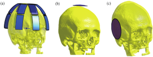 Numerical Evaluation of the Human Skull with Focused Ultrasound Stimulation