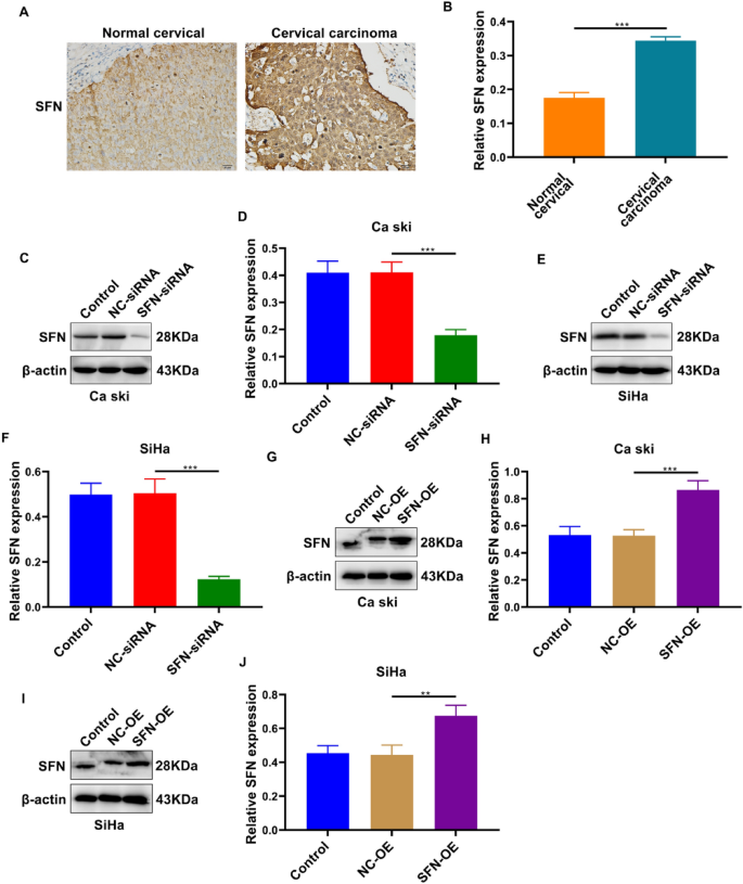 Stratifin (SFN) Regulates Cervical Cancer Cell Proliferation, Apoptosis, and Cytoskeletal Remodeling and Metastasis Progression Through LIMK2/Cofilin Signaling.