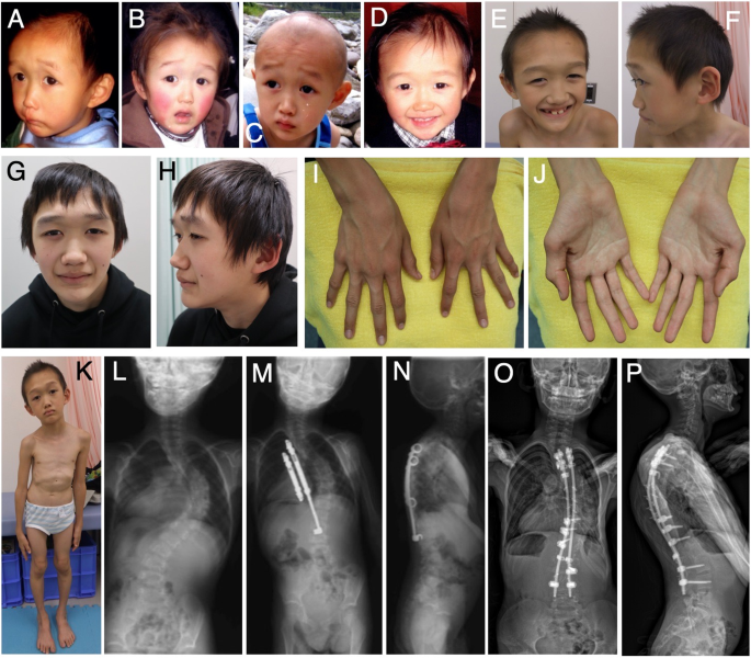 Atypical Sotos syndrome caused by a novel splice site variant.