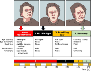 Clinical signs of the transition of syncope into hypoxic coma: a case report.