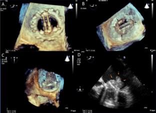 Monocyte to HDL ratio may predict thrombosis in patients with mechanical mitral and aortic valve prosthesis.