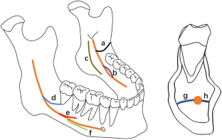 Prevalence and characteristics of accessory mandibular canals in an eastern Chinese population by cone beam computed tomography.