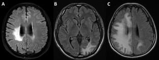 Epileptic seizures associated with progressive multifocal leukoencephalopathy in HIV-infected patients in Korea.